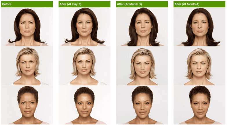 Botox before and after photos botox injection doylestown