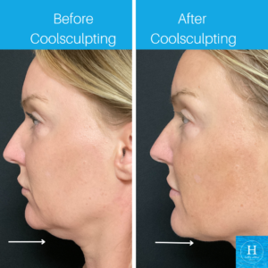 coolsculpting coolmini double chin reduction bucks county pa