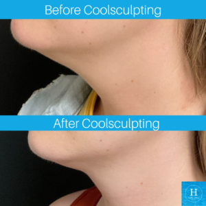 coolsculpting coolmini double chin reduction bucks county pa