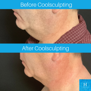 coolsculpting coolmini double chin reduction bucks county pa