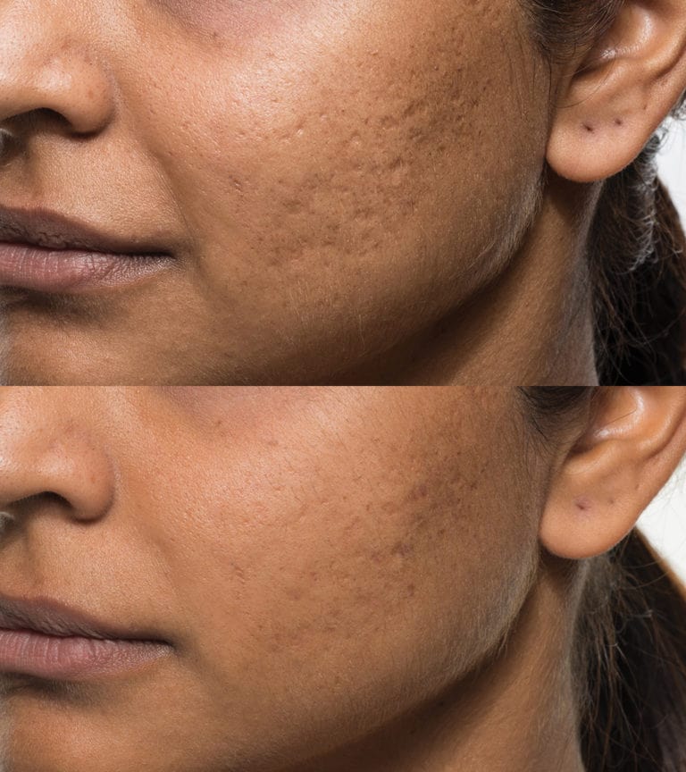 Bellafill Treatment For Reducing Acne Scars Fda Cleared 