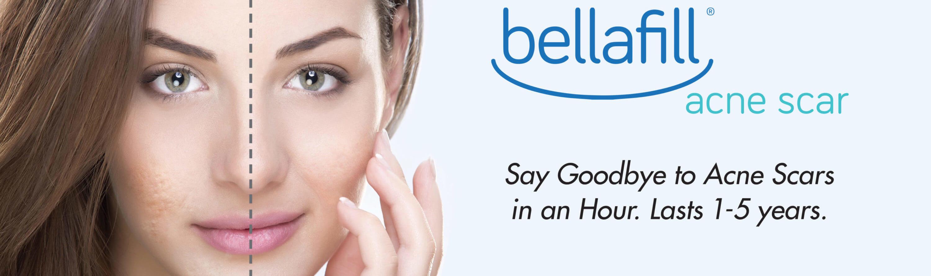 Bellafill Treatment For Reducing Acne Scars Fda Cleared 6294