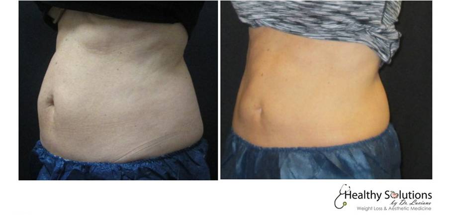 does coolsculpting work