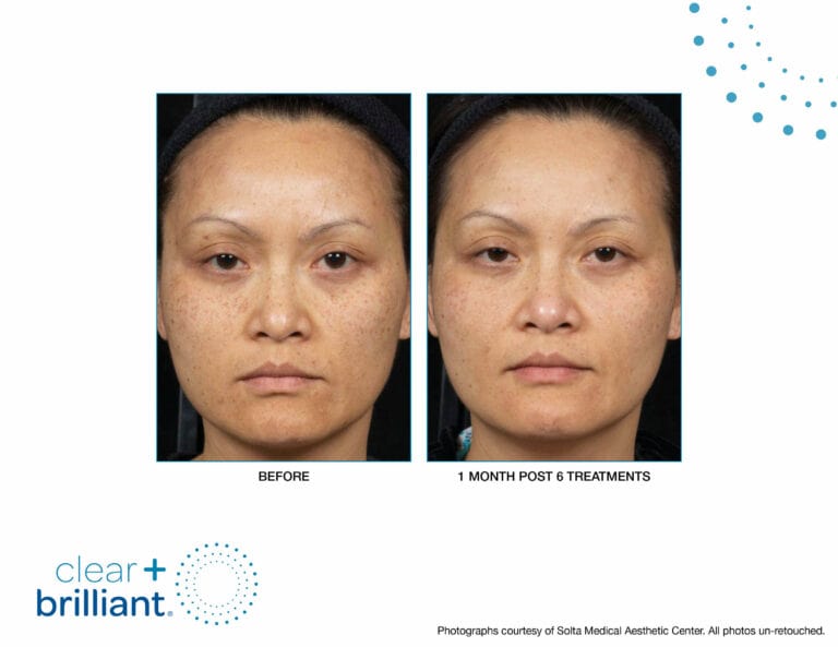 Clear and Brilliant before and after