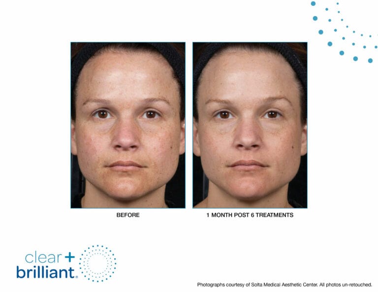 clear and brilliant before and after photo