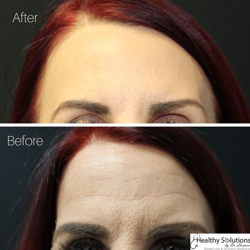 Before & After Photos Botox at Healthy Solutions by Dr. Luciano Medpsa