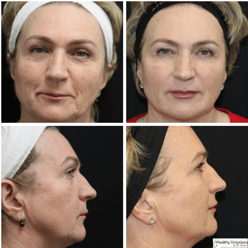 Before and After Cheek filler