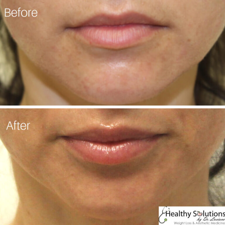 How Long Do Lip Injections Last? Juvederm Ultra, Volbella, and