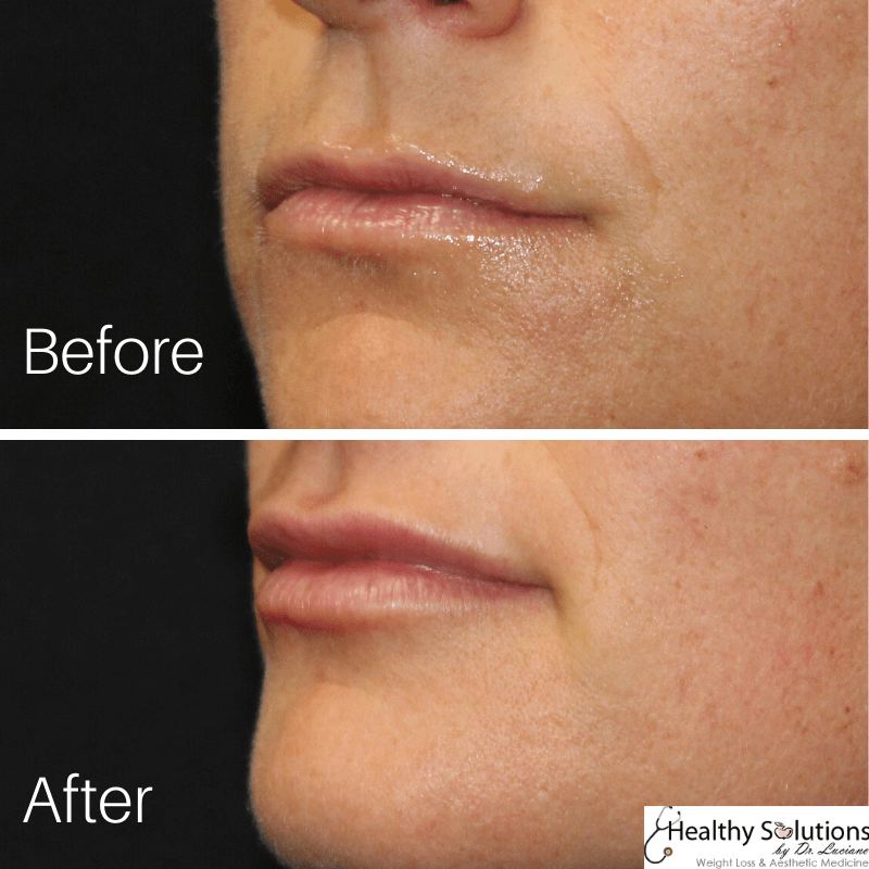 Before and after photo lips at Healthy Solutions by Dr. Luciano
