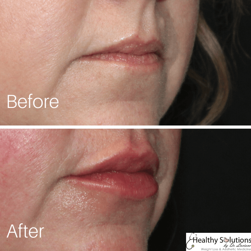 Before and after photo lips at Healthy Solutions by Dr. Luciano