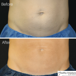 Coolsculpting before and after belly fat