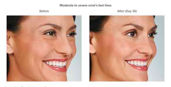 Botox Before and After Moderate to Severe crow's feet lines