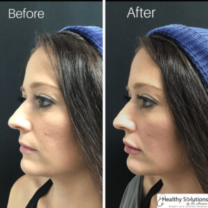 lip filler before and after photo lip augmentation lip injections