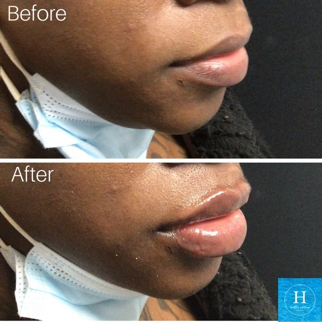 lip filler before and after photo Healthy Solutions Medspa