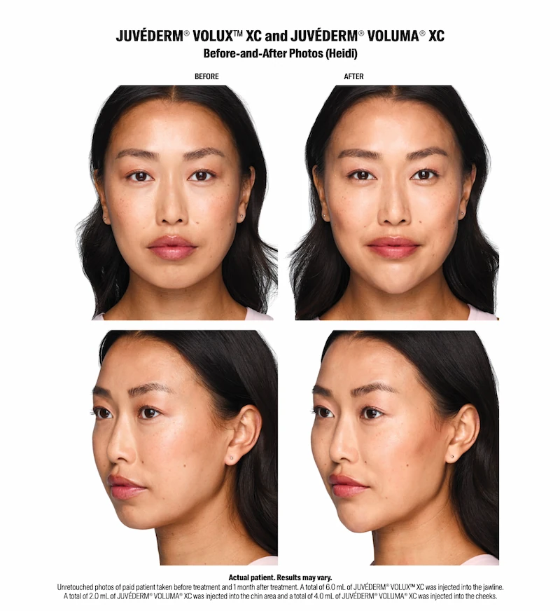 Juvederm before and after photos