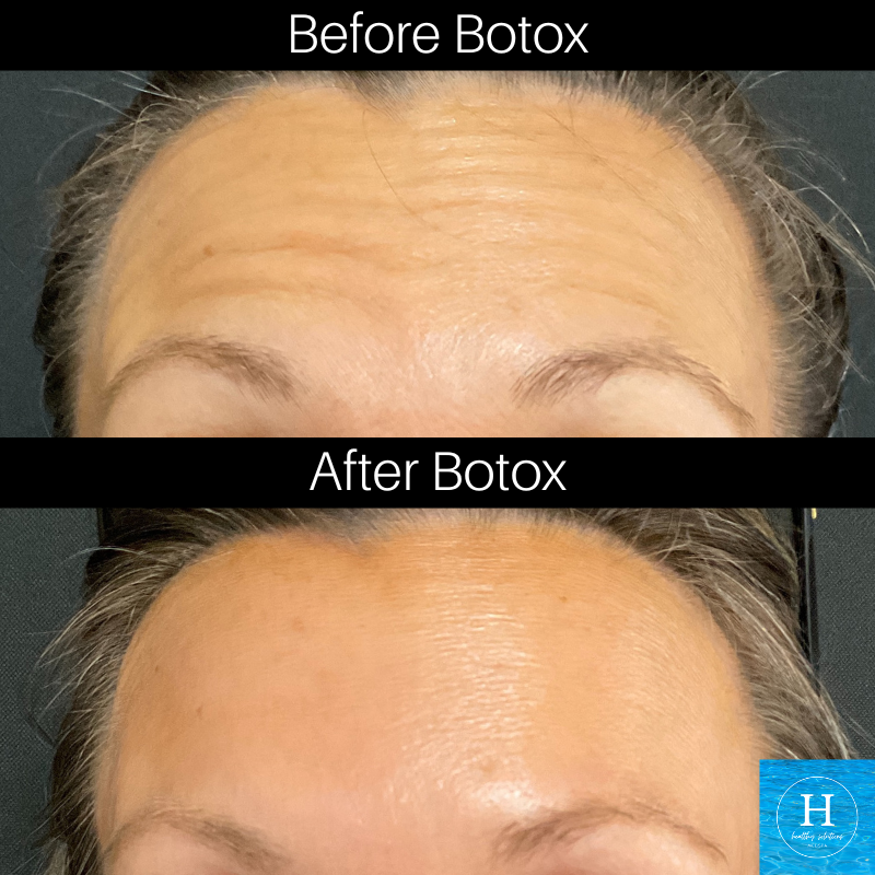 Botox before and after Botox Warminster Doylestown