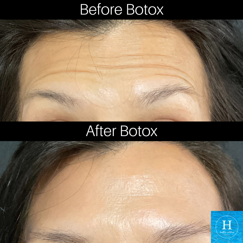 Botox before and after Botox Warminster