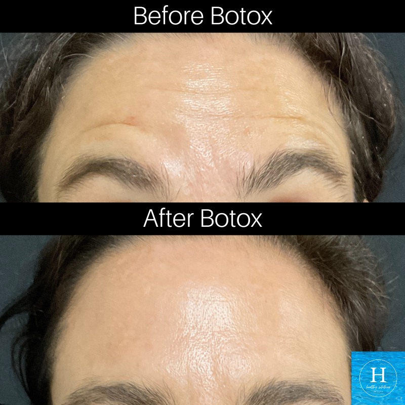 Botox before and after Doylestown Newtown Warminster New Hope