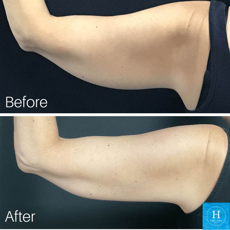 Coolsculpting before and after photo Arm Fat Healthy Solutions Medspa