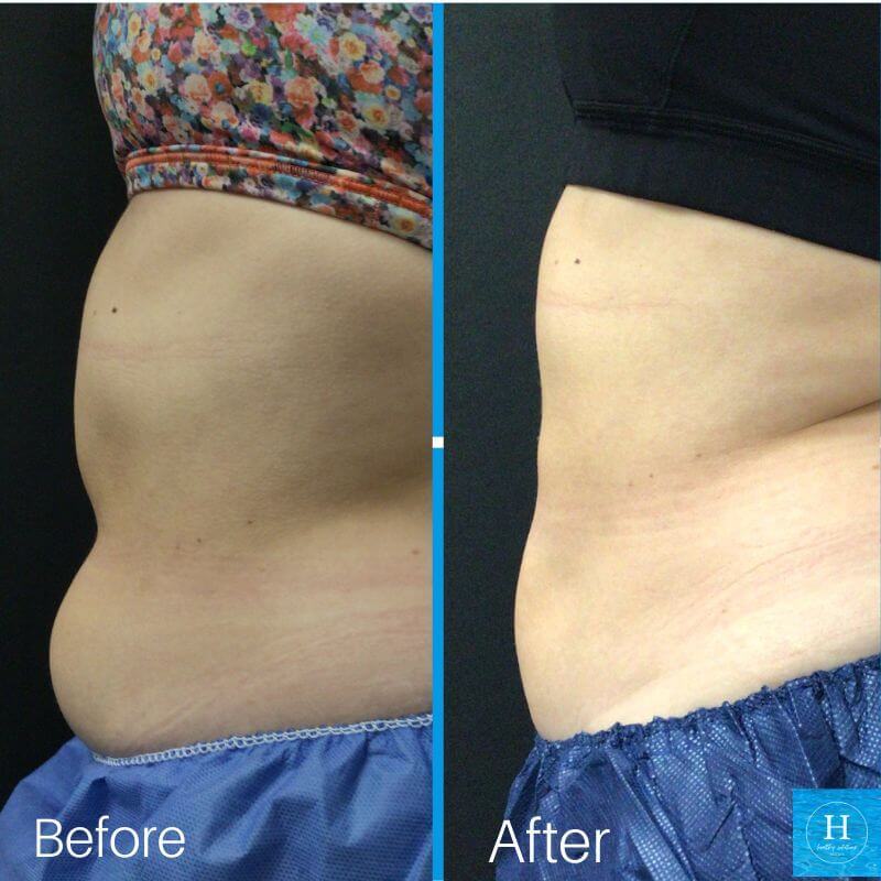 Coolsculpting before and after photo Healthy Solutions Medspa Bucks County, PA