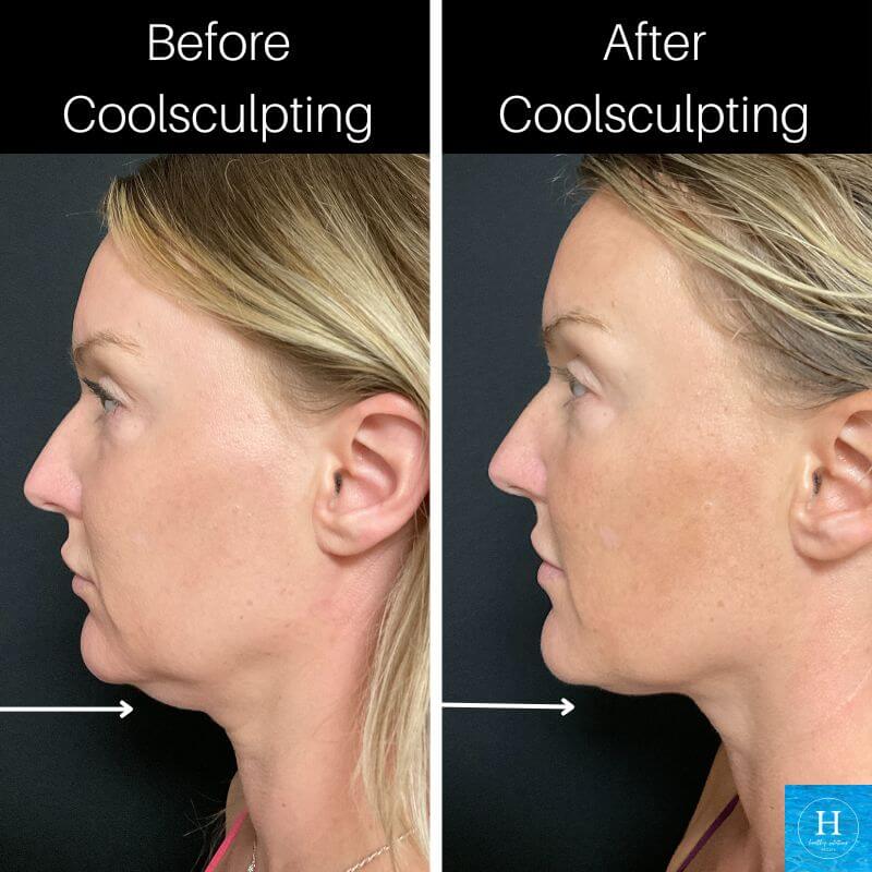 Coolsculpting before and after photo Healthy Solutions Medspa Double Chin