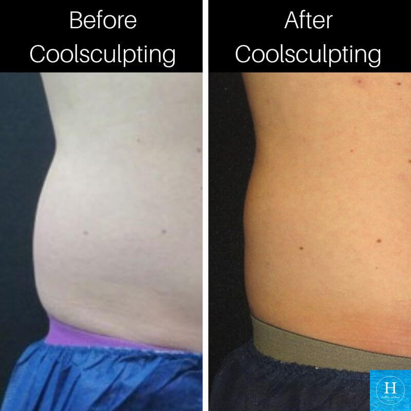 Coolsculpting before and after photo Healthy Solutions Medspa Love Handles