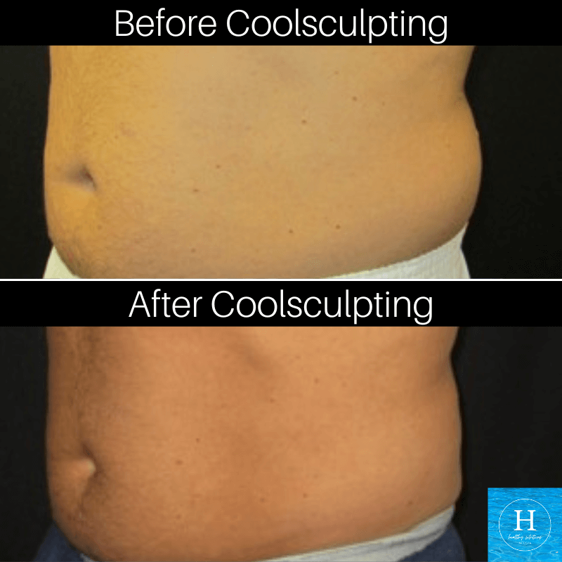 Coolsculpting before and after photo Healthy Solutions Medspa Love Handles Men