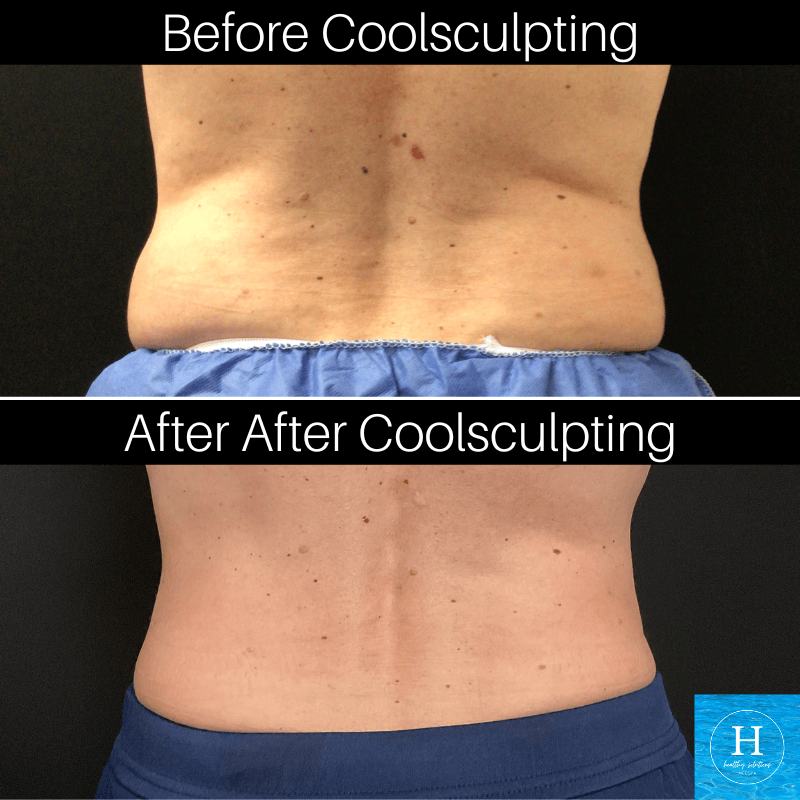 Coolsculpting before and after photo Healthy Solutions Medspa