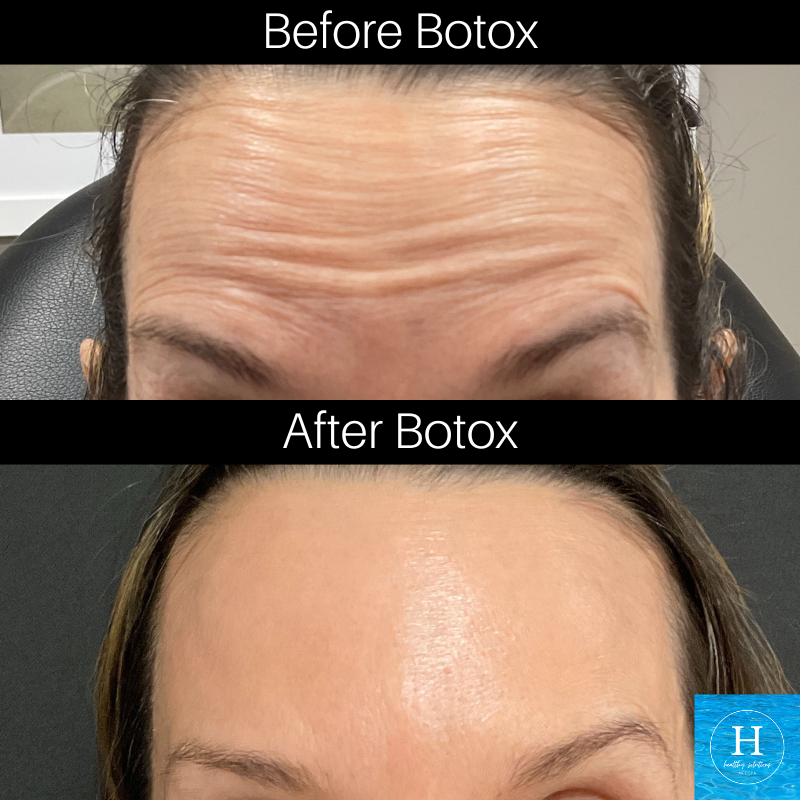 Save $100 Off Your First Botox Treatment with Alle's New Coupon ...