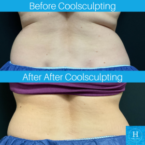 coolsculpting