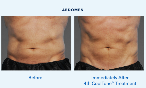 Cool tone before and after of abdomen