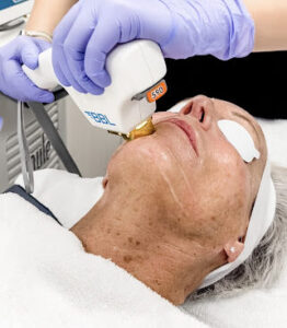 bbl photofacial doylestown