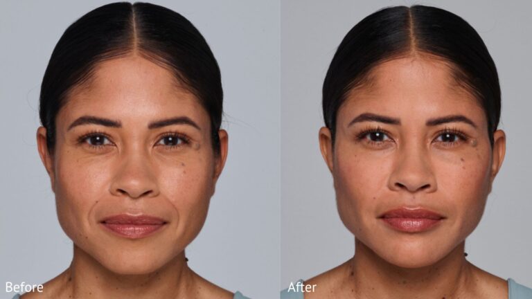 juvederm voluma fda approved for temples bucks county pa