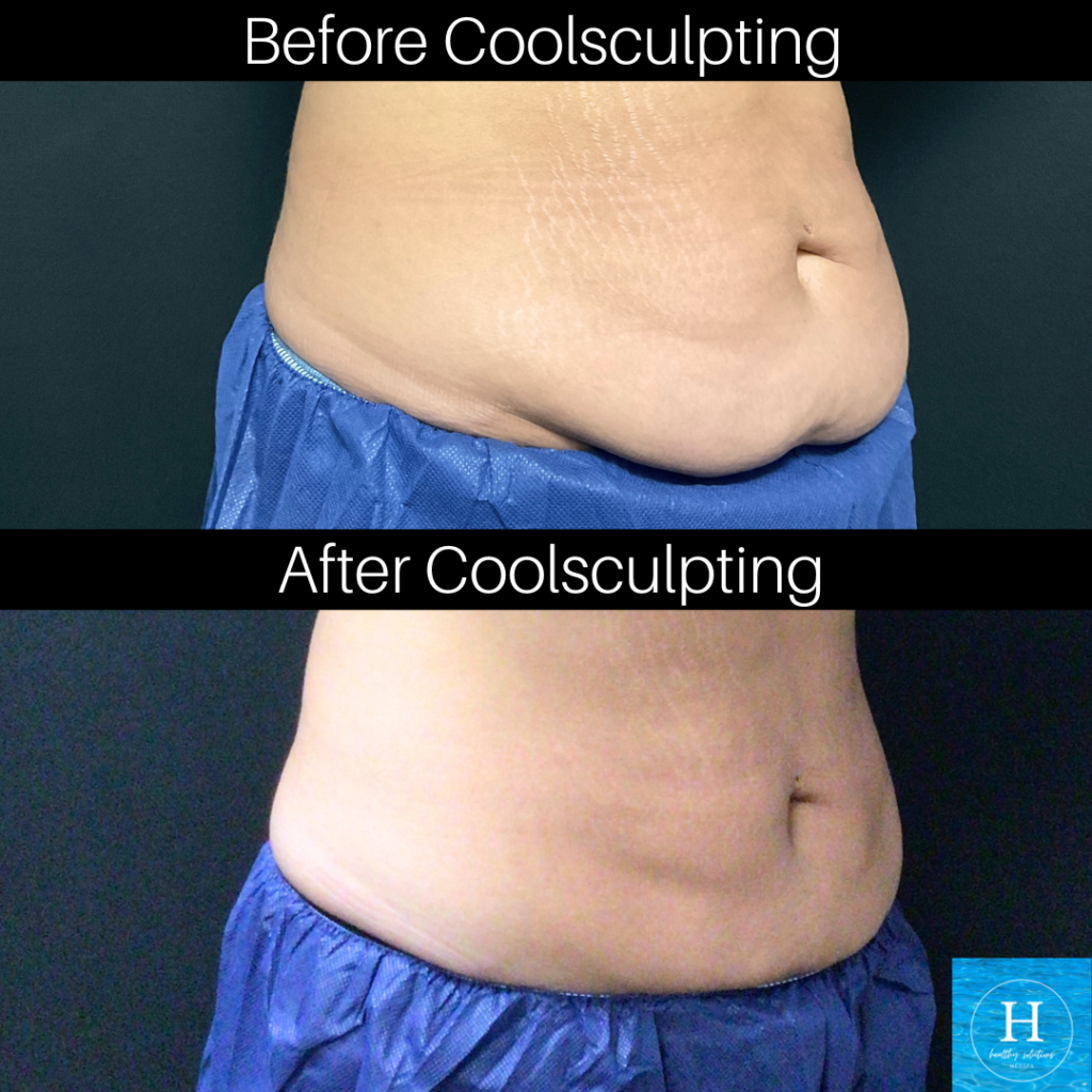 CoolSculpting before and after abdomen