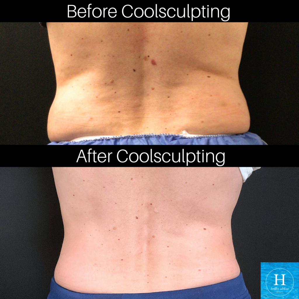 Coolsculpting before and after love handles