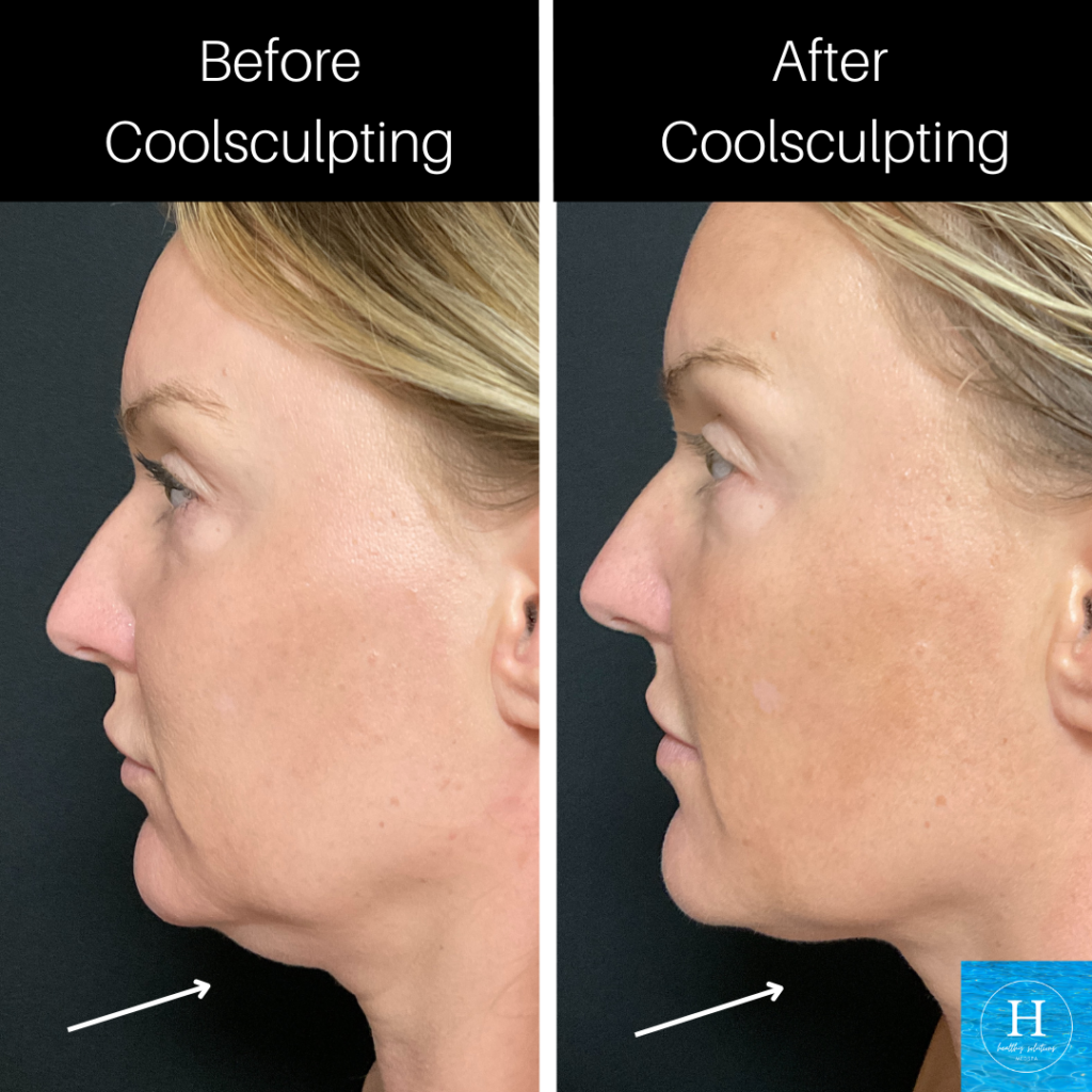 Coolsculpting after weight loss double chin