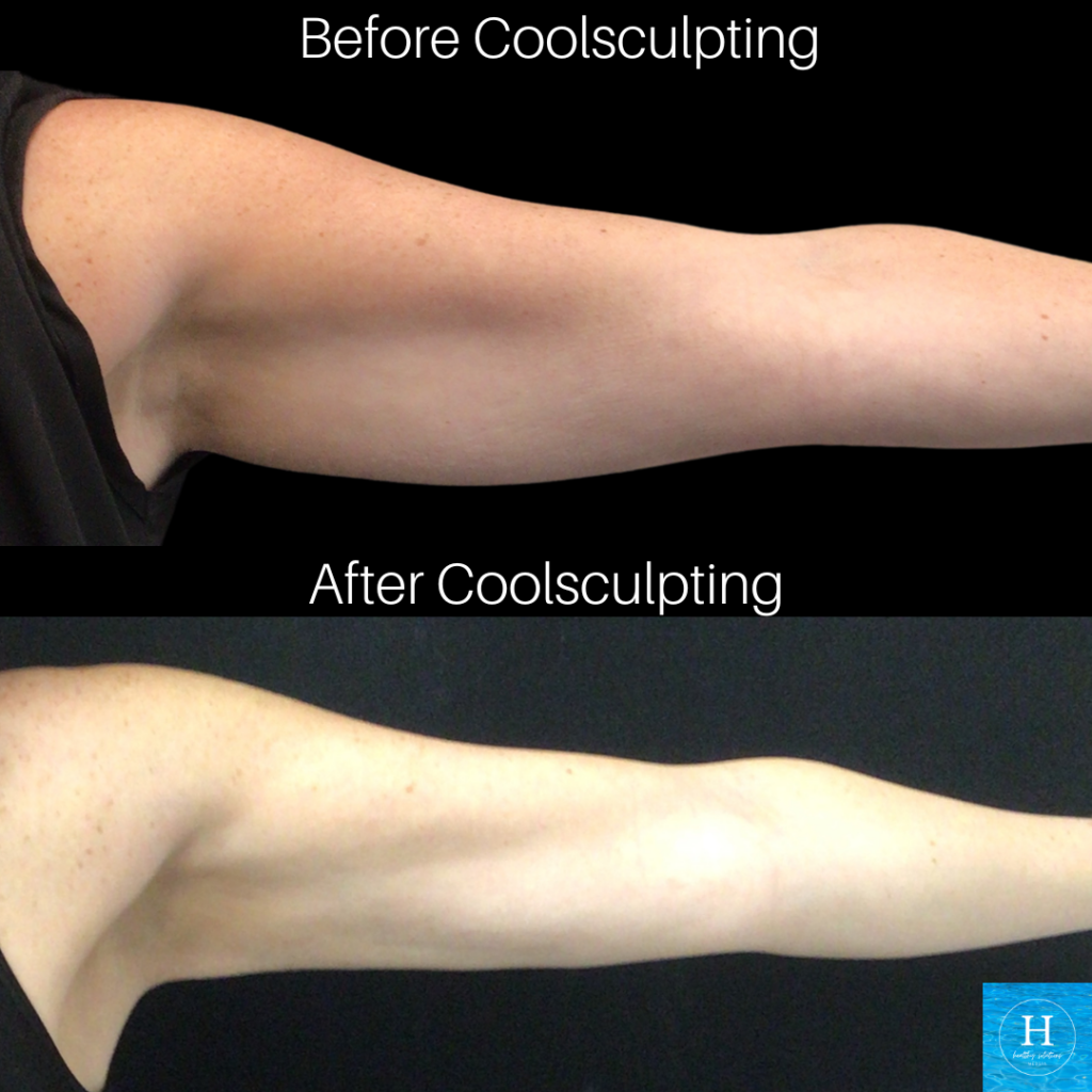 Coolsculpting before and after Arms