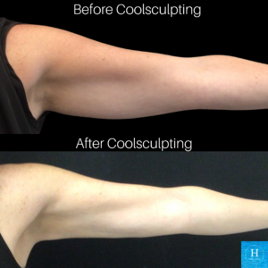Coolsculpting before and after Arms Healthy Solutions Medspa Doylestown Warminster, PA