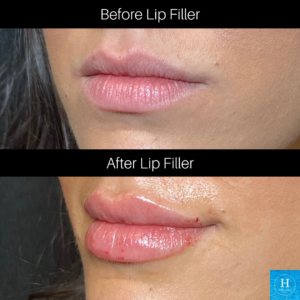 lip filler