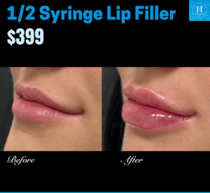 lip filler promo