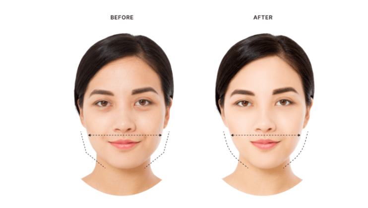 Masseter-Botox-Slim-Your-Jawline-Without-Surgery