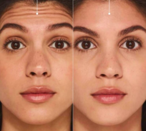 botox before and after