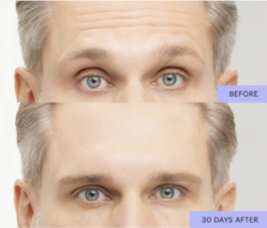 botox before and after