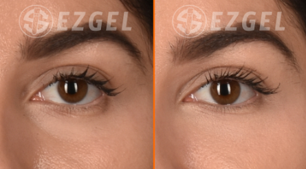 Ez Gel Tear Troughs Before and After Healthy Solutions Medspa