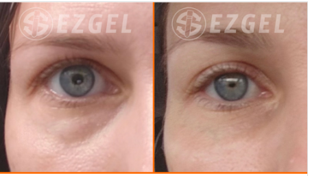 Ez Gel Tear Troughs Before and After Healthy Solutions Medspa