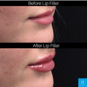 lip filler at Healthy Solutions Medspa doylestown warminster