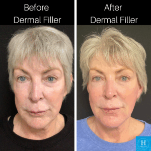 Dermal Filler Near Me Juvederm Voluma at Healthy Solutions Medspa doylestown Warminster