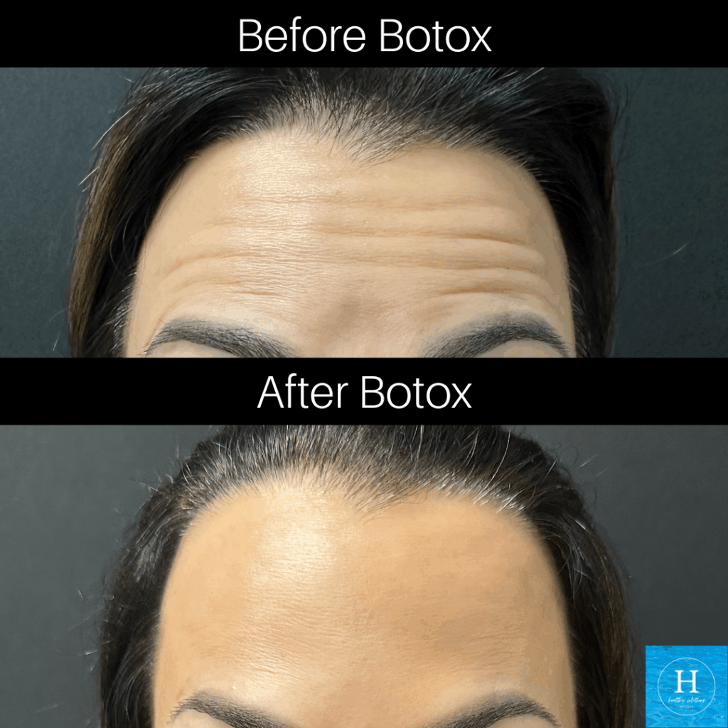 #1 Botox provider Doylestown Warminster Healthy Solutions Medspa