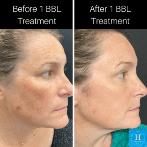 BBL Photofacial Near Me doylestown