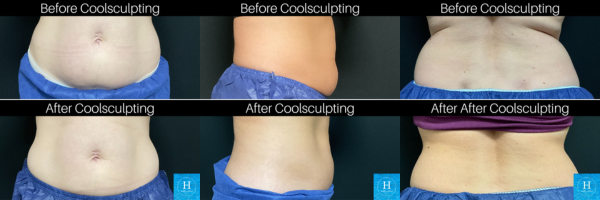 Coolsculpting before and after photos at Healthy Solutions Medspa